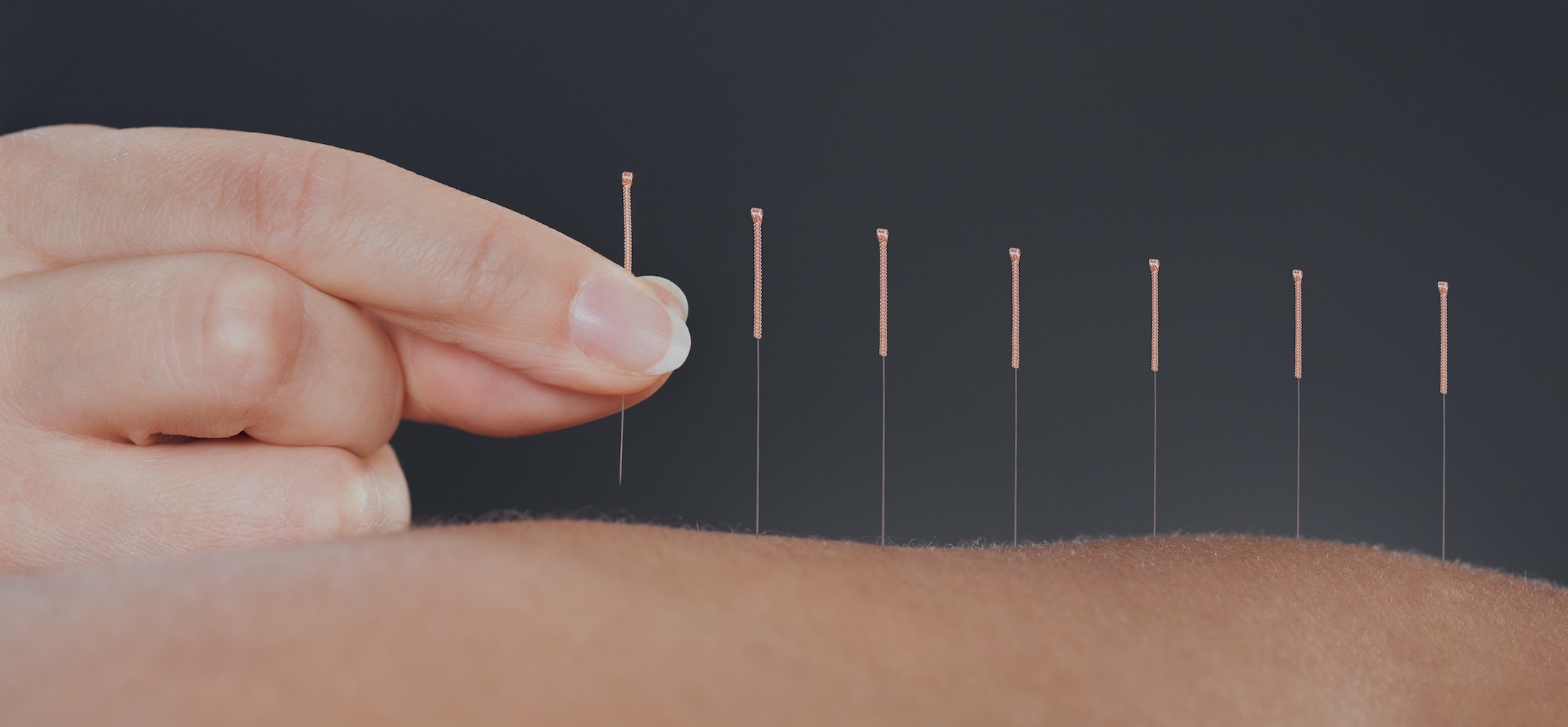 Acupuncture needles being inserted into a person's back